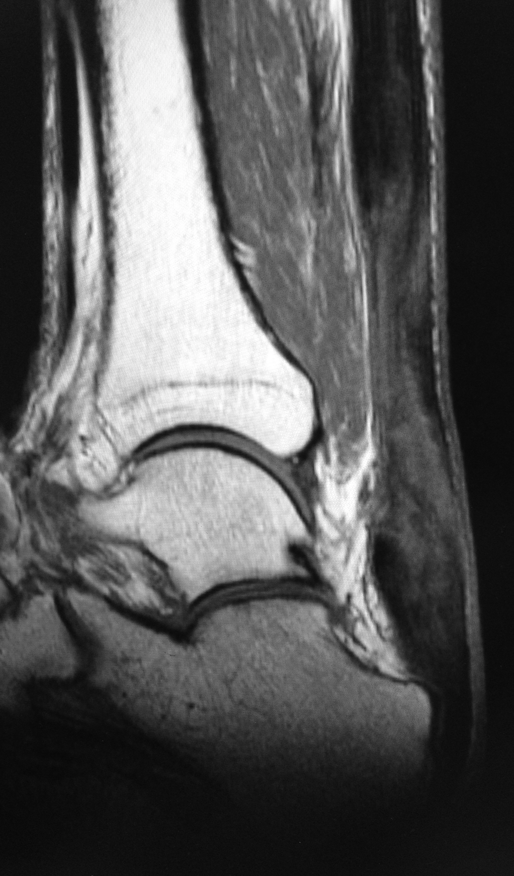 Achilles Tendon Rupture & Reconstruction | David Redfern Surgery